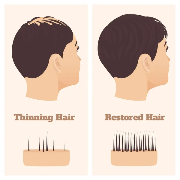 Mujer en vista lateral antes y después del tratamiento de pérdida de cabello — Vector de stock