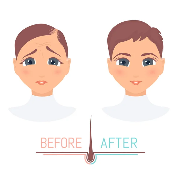 Woman before and after hair loss treatment in front view — Stock Vector