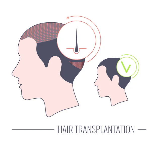 Transplantation de cheveux modèle médical linéaire de traitement réussi — Image vectorielle