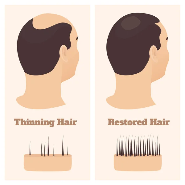 Hombre en vista lateral antes y después del tratamiento de pérdida de cabello — Archivo Imágenes Vectoriales