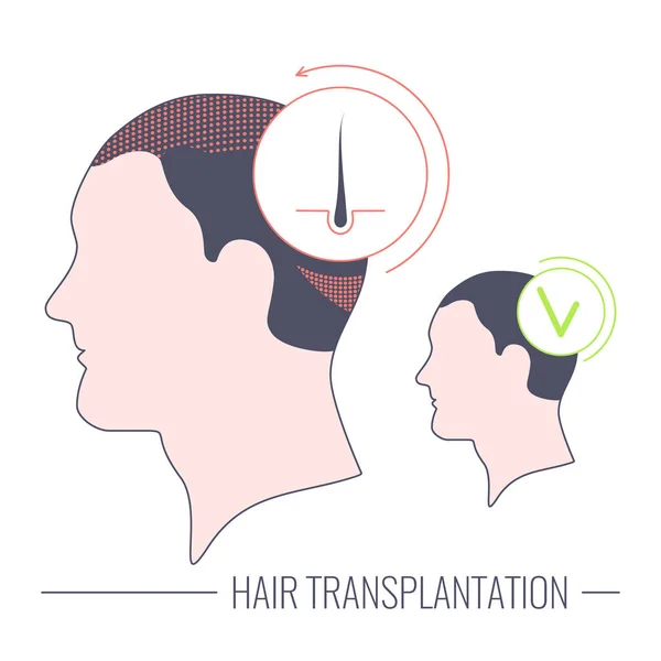 Trasplante de cabello concepto médico lineal de tratamiento exitoso — Vector de stock