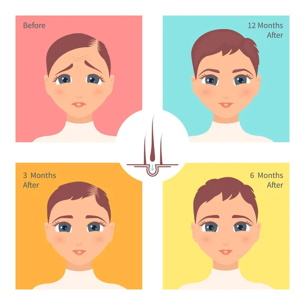 Hair transplantation surgery result in women after three, six and twelve months — Stock Vector