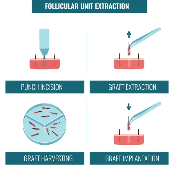 FUE haartransplantatie procedure fasen medische infographics — Stockvector