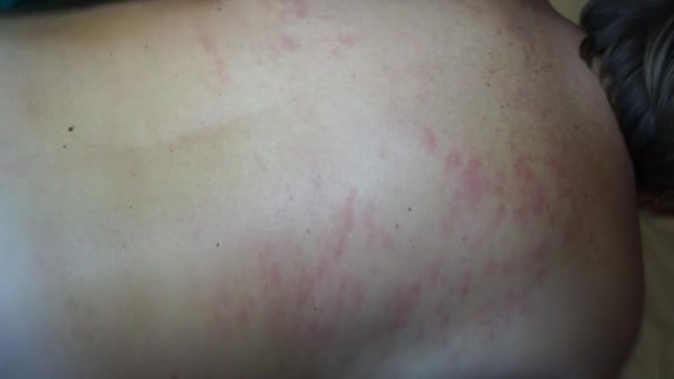 Massaggio alla schiena. Le mani maschili del medico fanno un massaggio terapeutico sul corpo di una donna. I metodi professionali lavorano sui muscoli della schiena, li rilassano, rompendo i punti di innesco . — Video Stock