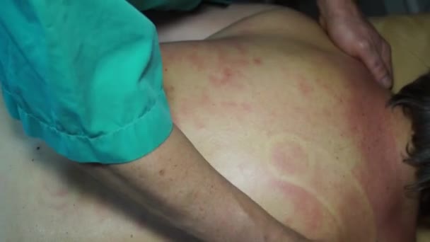 Manliga händerna på läkaren göra en terapeutisk massage på baksidan av kvinnan av bankerna. Professionella tekniker fungerar på musklerna i ryggen, koppla dem, att bryta triggerpunkter. — Stockvideo