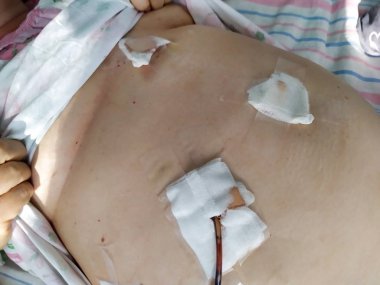 Safra kesesi hastalığının (safra kesesi alınması) laparoskopik kolesistektomi sonrası durumu. Karnındaki bandajlar ve drenaj tüpleri kan akışı için. Mobil fotoğraf.