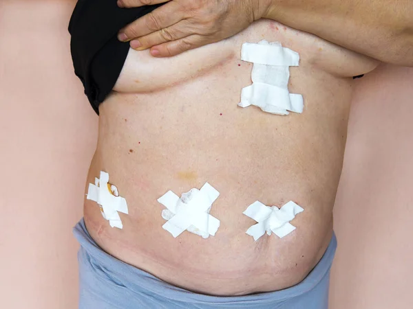 Condition after laparoscopic cholecystectomy for gallstone disease (removal of the gallbladder). Bandages in the abdomen.