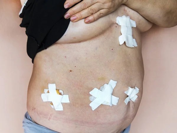 Safra kesesi hastalığının (safra kesesi alınması) laparoskopik kolesistektomi sonrası durumu. Karnında bandajlar var..