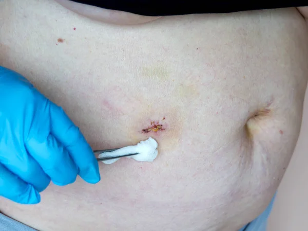 Safra kesesi hastalığının (safra kesesi alınması) laparoskopik kolesistektomi sonrası durumu. Yaraların tedavisi, karın bölgesinde giyinme..