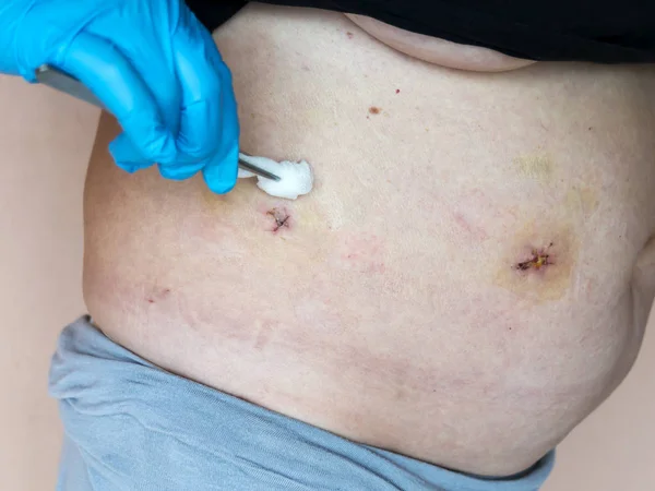 Safra kesesi hastalığının (safra kesesi alınması) laparoskopik kolesistektomi sonrası durumu. Yaraların tedavisi, karın bölgesinde giyinme..