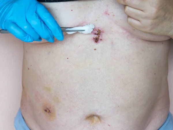 Safra kesesi hastalığının (safra kesesi alınması) laparoskopik kolesistektomi sonrası durumu. Yaraların tedavisi, karın bölgesinde giyinme..