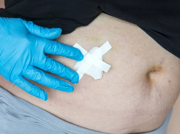 Safra kesesi hastalığının (safra kesesi alınması) laparoskopik kolesistektomi sonrası durumu. Yaraların tedavisi, karın bölgesinde giyinme..