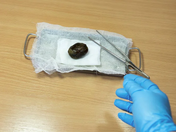 Geniş safra kesesi taşı yakın plan. Laparoskopik kolesistektomi sırasında alındı, safra kesesini almak için ameliyat oldu. Safra taşı hastalığının komplikasyonları. Cerrahın eli bir taşı işaret ediyor..