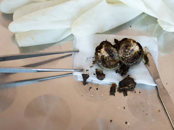 Geniş kristalize safra taşı, görüldüğünde kesilmiş. Beton laparoskopik kolesistektomi sırasında alındı. Safra kesesini almak için ameliyat. Safra taşı hastalığının komplikasyonları.