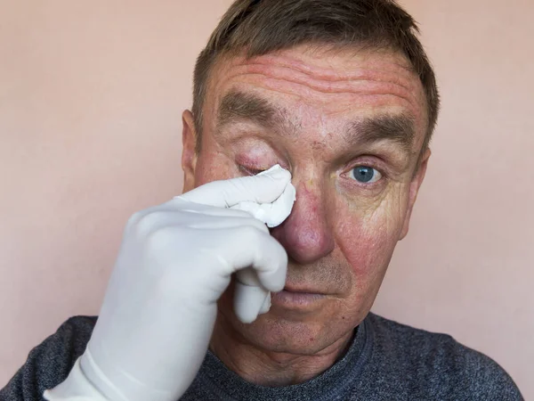Inspeção Tratamento Olhos Masculinos Com Medicamentos Oftalmologia Doença Ocular Prevenção — Fotografia de Stock