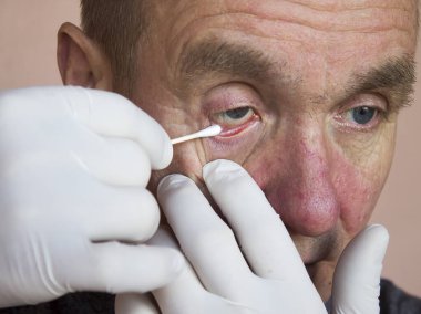 Göz sorunu olan bir adam. Göz merheminin konjonktivit tedavisi için kullanılması. Oftalmoloji. Göz hastalıklarının önlenmesi ve tedavisi.