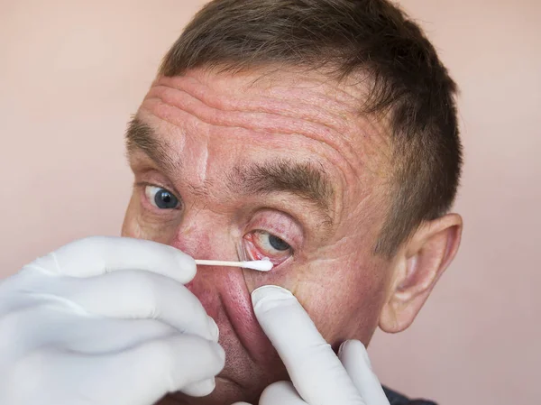 Göz sorunu olan bir adam. Göz merheminin konjonktivit tedavisi için kullanılması. Oftalmoloji. Göz hastalıklarının önlenmesi ve tedavisi.