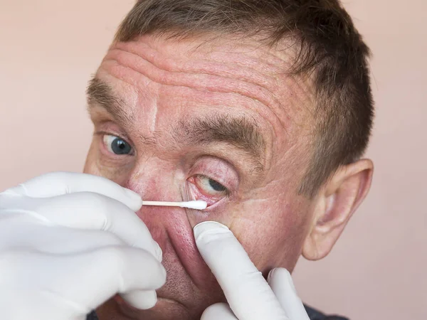 Homem Com Problemas Oculares Uso Pomada Ocular Para Tratamento Conjuntivite — Fotografia de Stock