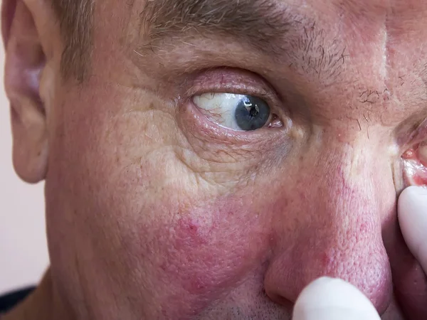 Demodekóza Obličeje Očí Muže Vyšetření Léčba Oftalmologie Kožní Onemocnění Prevence — Stock fotografie