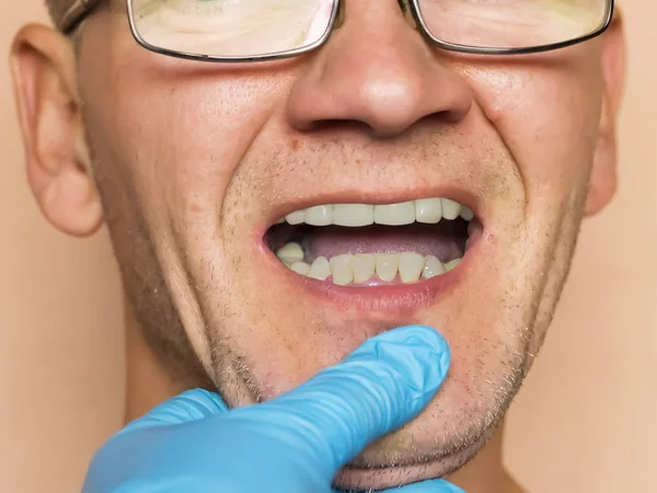 Dentes doentes. Podridão severa, cárie, perda de dentes. Um homem examinado b — Fotografia de Stock