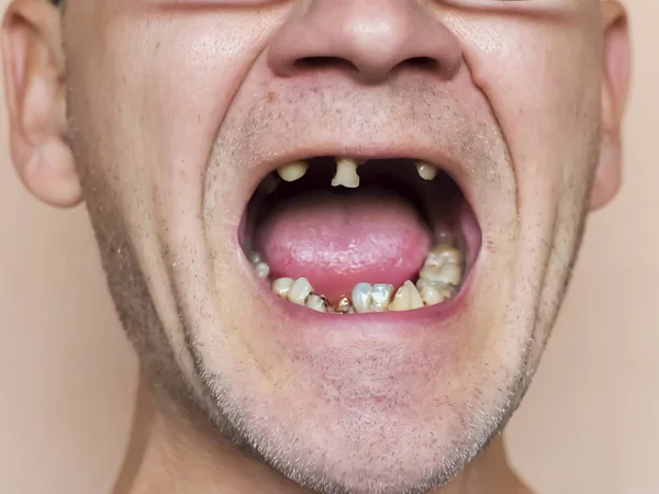 Diseased teeth. Severe rot, caries, tooth loss. A man examined b