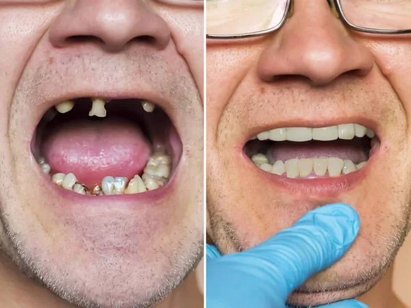 Dientes enfermos. Podredumbre severa, caries, pérdida de dientes. Un hombre examinado b Imagen de stock