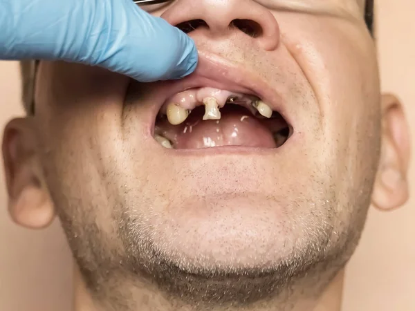 Denti Malati Grave Marciume Carie Perdita Dei Denti Uomo Esaminato Foto Stock