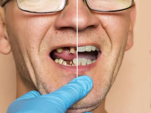 Hastalıklı dişler. Yoğun çürüme, bakteriler, diş dökülmesi. Muayene edilen bir adam.