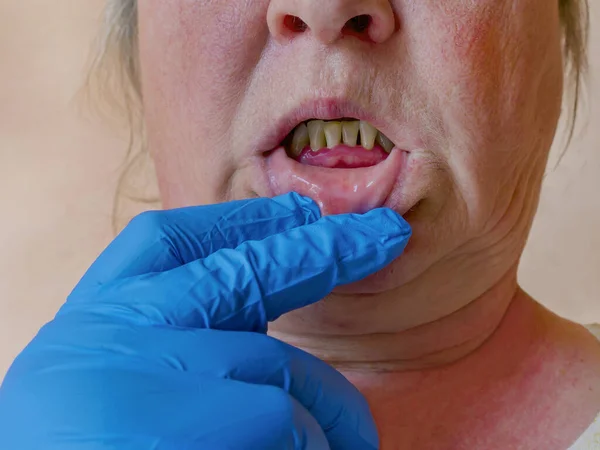 Periodontitis, un proceso inflamatorio en las encías. Exposición de — Foto de Stock