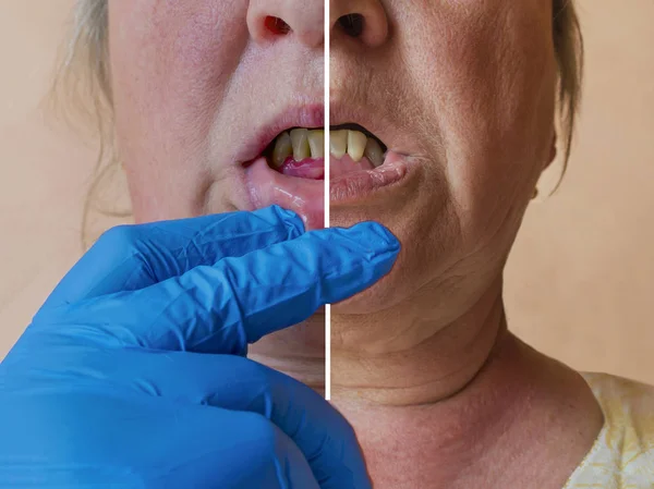 Parodontit, en inflammatorisk process i tandköttet. Exponering för — Stockfoto