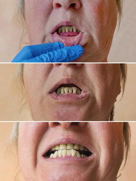 Tillståndet i munhålan efter behandling av tandköttsproblem, — Stockfoto