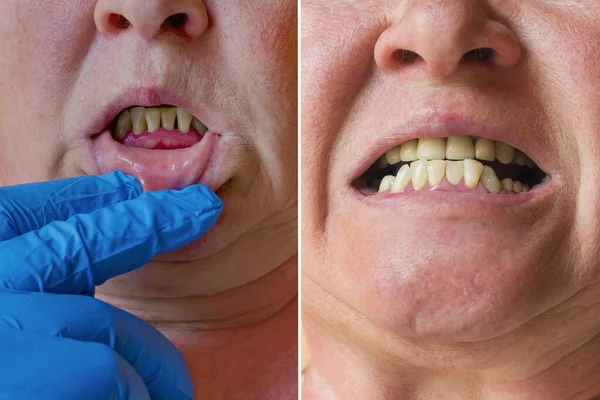Periodontitis, an inflammatory process in the gums. Exposure of Royalty Free Stock Photos