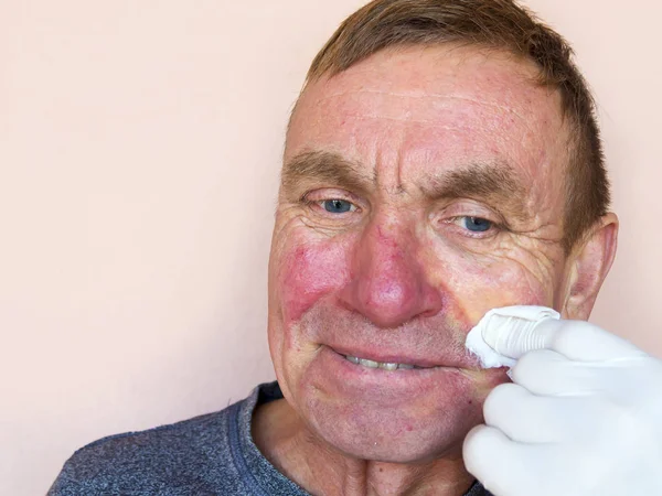 Demodecose Face Homem Luvas Faz Tratamento Pele Facial Com Medicamentos — Fotografia de Stock