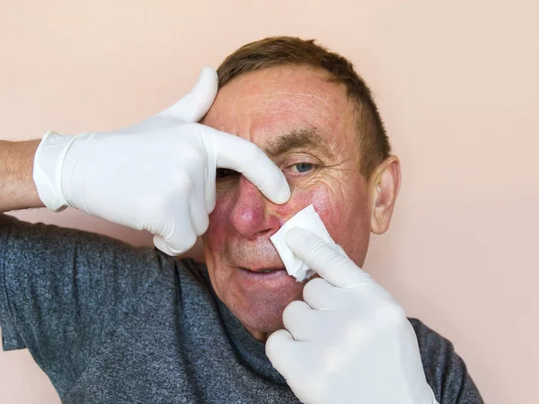 Demodecose Face Homem Luvas Faz Tratamento Pele Facial Com Medicamentos — Fotografia de Stock