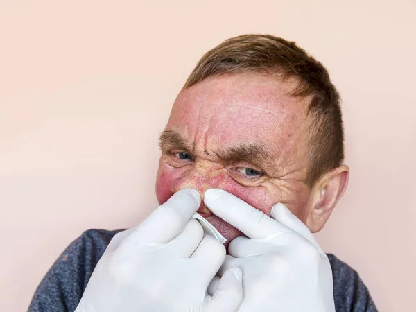 面部脱落感 戴手套的男人用药物治疗面部皮肤 预防和治疗皮肤病 — 图库照片