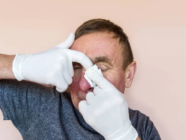 Demodecose Face Homem Luvas Faz Tratamento Pele Facial Com Medicamentos — Fotografia de Stock