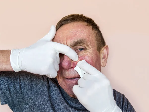 面部脱落感 戴手套的男人用药物治疗面部皮肤 预防和治疗皮肤病 — 图库照片