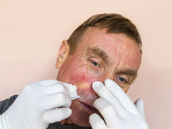 Demodecosis Cara Hombre Con Guantes Hace Tratamiento Piel Facial Con Imagen de archivo