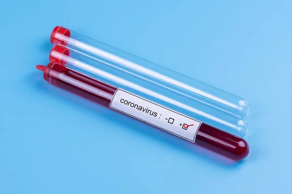 Koronawirus. Próbka krwi do analizy in vitro. Lekarstwo. Analizuję. Wirusy. — Zdjęcie stockowe