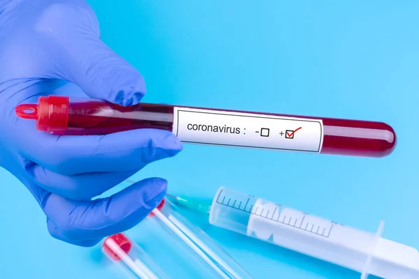 Koronawirus. Lekarze podają rękawicę medyczną. Próbka krwi do analizy in vitro. Analizuję. Wirusy. — Zdjęcie stockowe