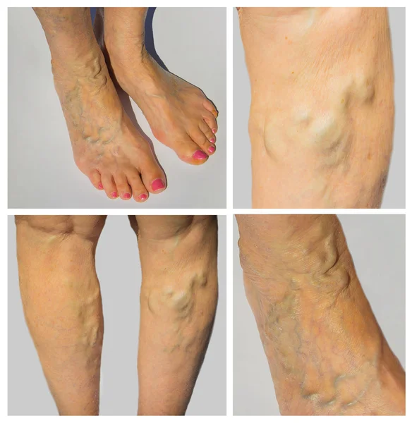 Venas varicosas en piernas femeninas — Foto de Stock