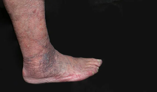 Varicose Veins Leg Old Man Black — Stock Photo, Image