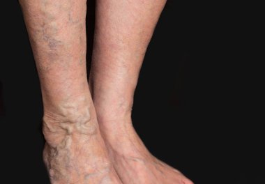 Bir kadın ayak üzerinde varisli damarlar