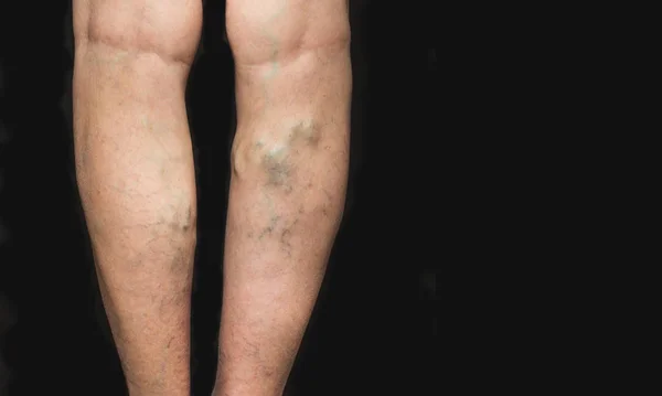 Varices sur les jambes d'une femme — Photo