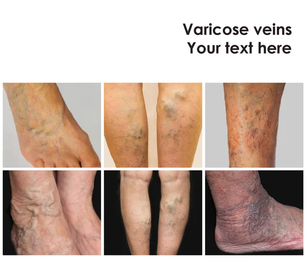 Collage from images of varicose veins — Stock Photo, Image