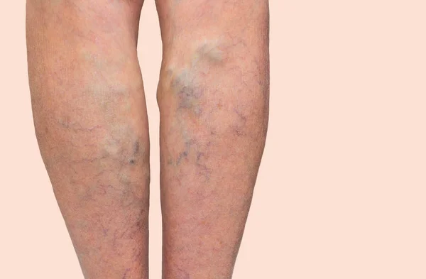 Vene varicose su gambe femminili — Foto Stock