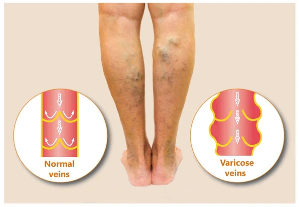 Venas varicosas en una pierna mayor femenina —  Fotos de Stock