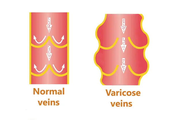 Le vene varicose e le vene normali — Foto Stock