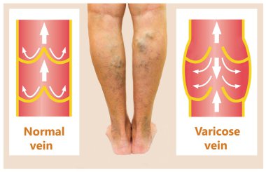 Bir kadın kıdemli bacakta varis