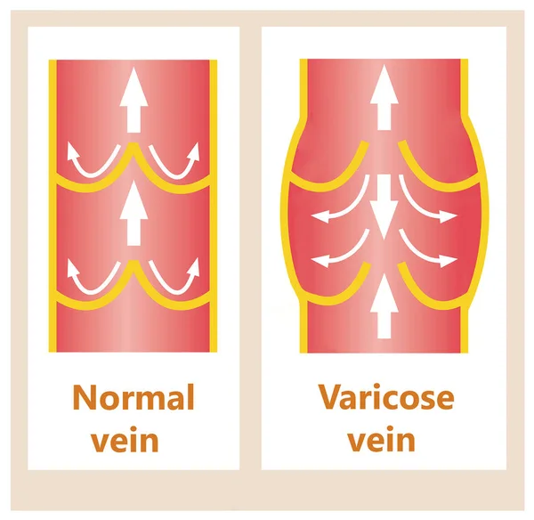 The varicose veins and normal veins